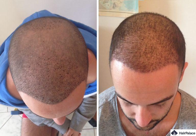 Area impiantata 1 e 3 settimane dopo il trapianto di capelli FUE2