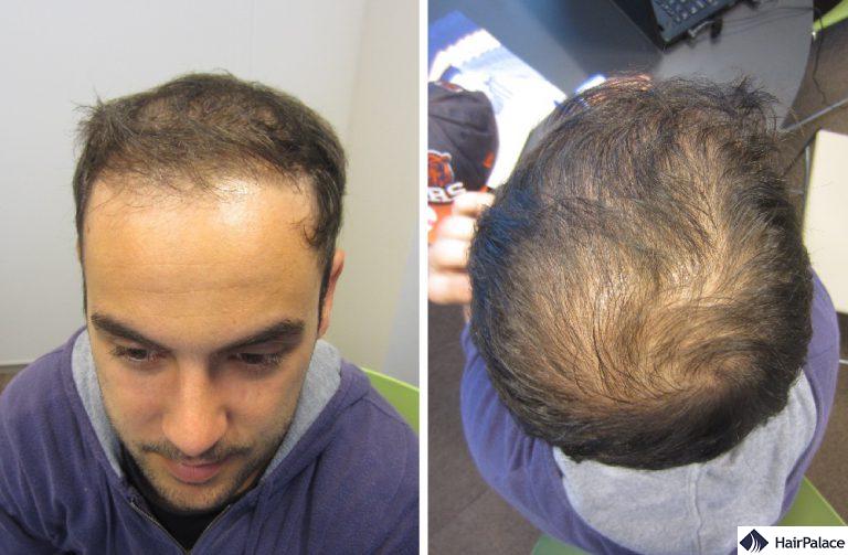L'attaccatura dei capelli e la corona di Cyril nel 2014 prima del suo intervento FUE2