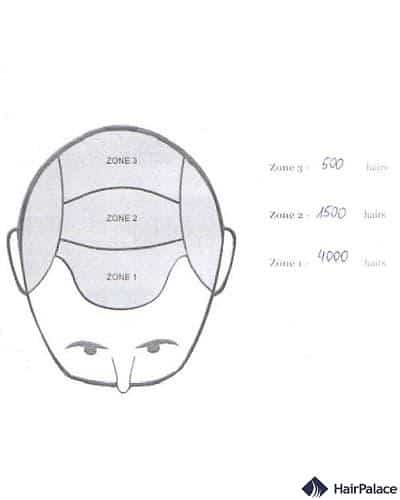 Distribuzione dei capelli – Primo  intervento chirurgico