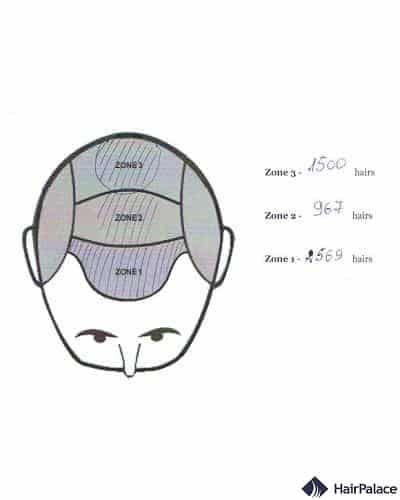 Distribuzione dei capelli – Secondo  intervento chirurgico