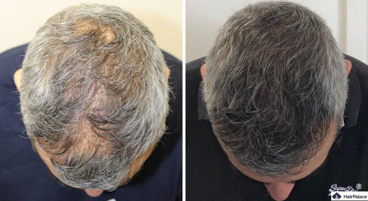 Risultati del trapianto di capelli Fue presso HairPalace