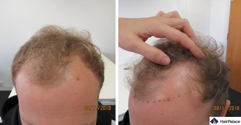 Abbozzo dell'attaccatura dei capelli fatto in occasione della consulenza