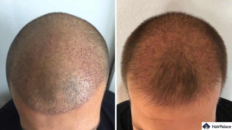 L'area impiantata 1 e 3 settimane dopo il trapianto di capelli