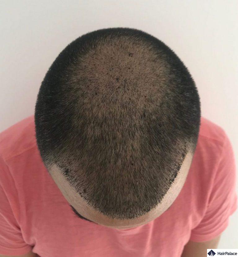 foto di controllo 1 settimana dopo il trapianto di capelli con croste visibili