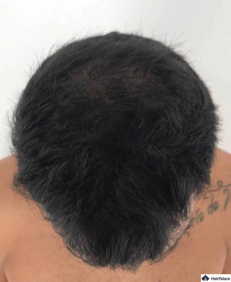 Yohann 6 mesi dopo l'intervento chirurgico con circa il 50% dei capelli impiantati cresciuti