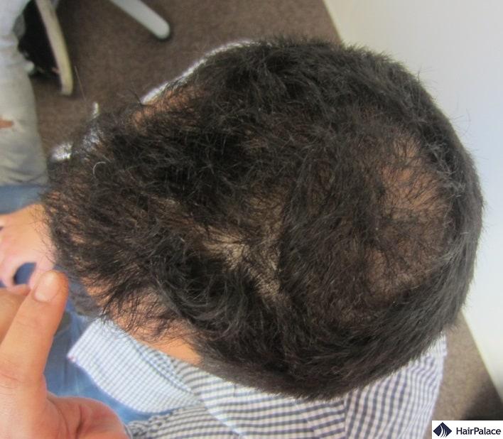 I capelli di Yohanns prima dell'intervento