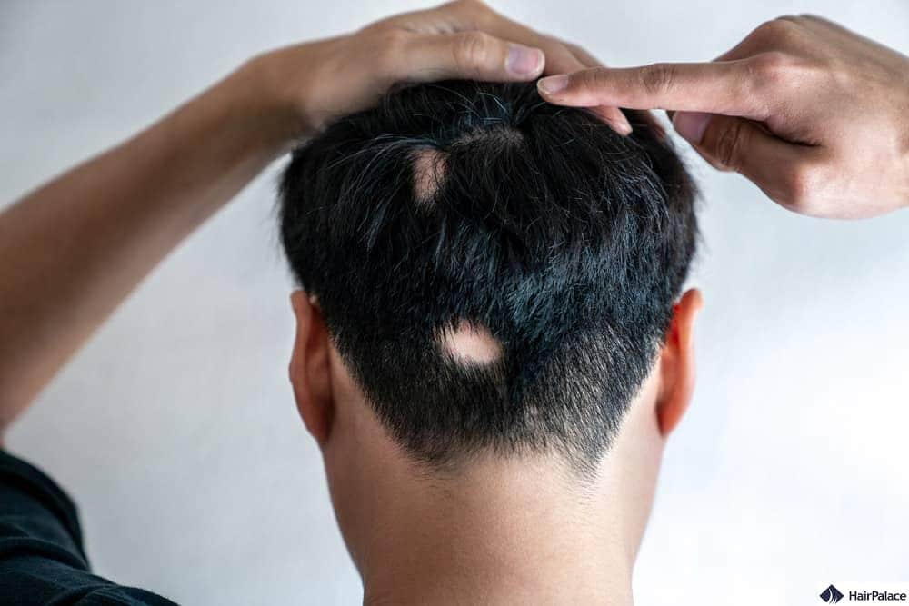 Alopecia areata: segni di calvizie