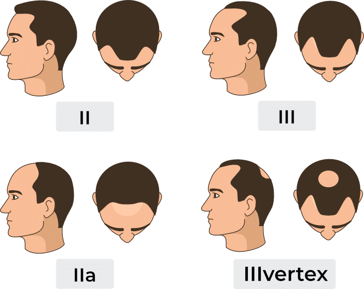 Costo del trapianto di capelli