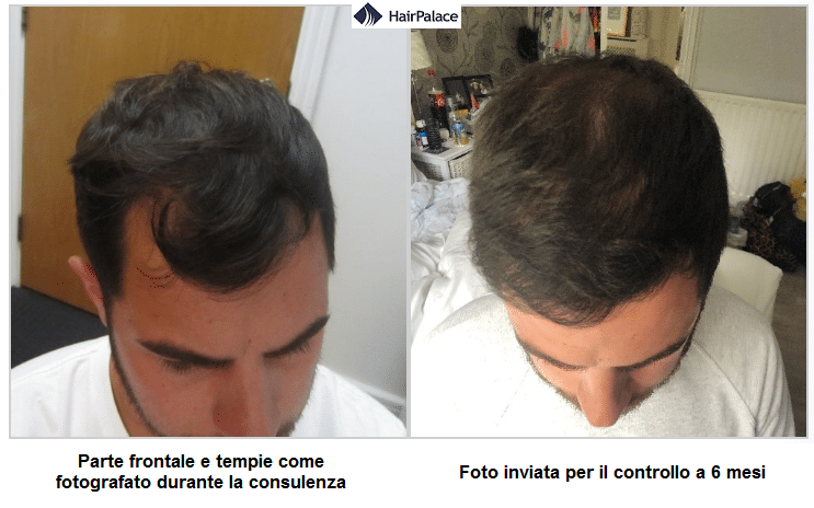 trapianto di capelli chris