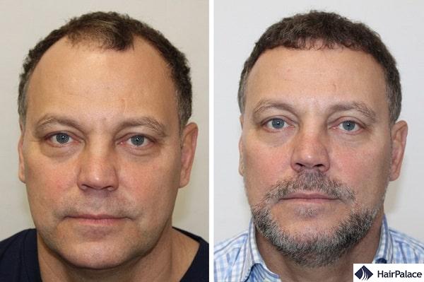 Il ripristino dell'attaccatura con il trapianto dei capelli