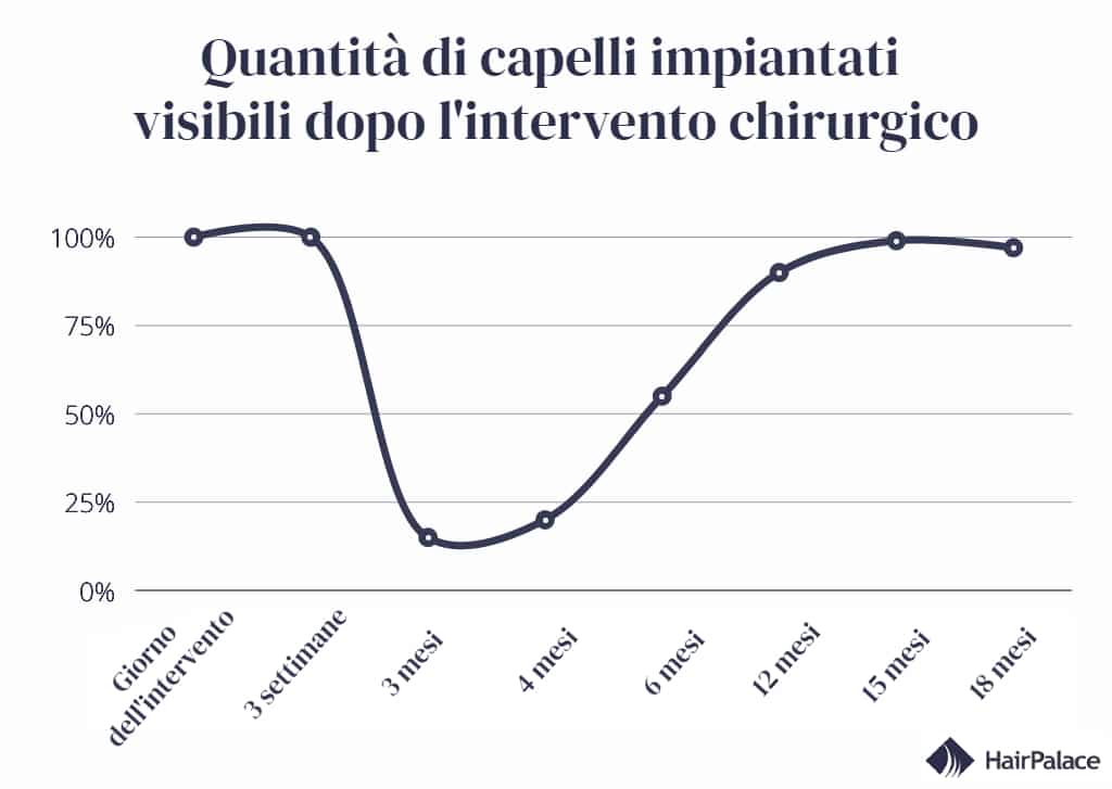 quantità di capelli impiantati visibili mesi dopo il trapianto di capelli