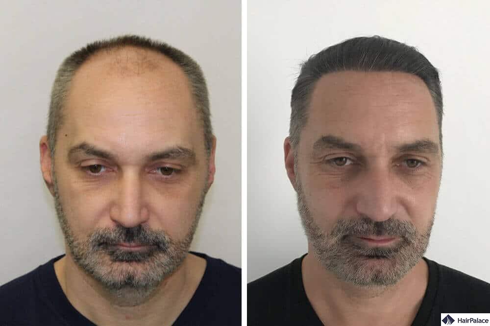 Nick - risultato del trapianto di capelli maschili invecchiati
