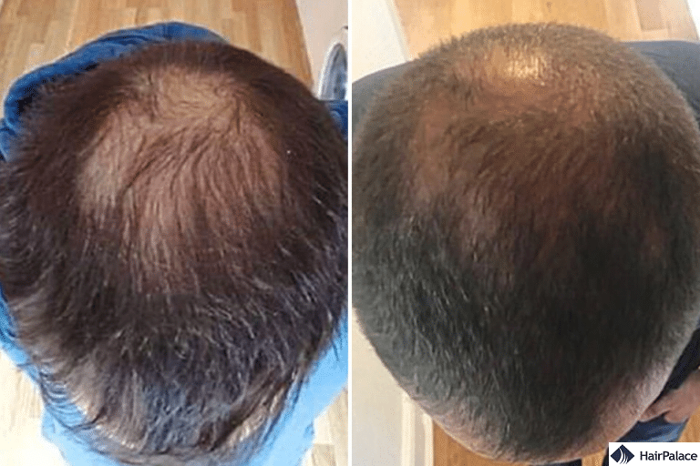 Quanto tempo ci vuole per riprendersi da un trapianto di capelli con cellule staminali