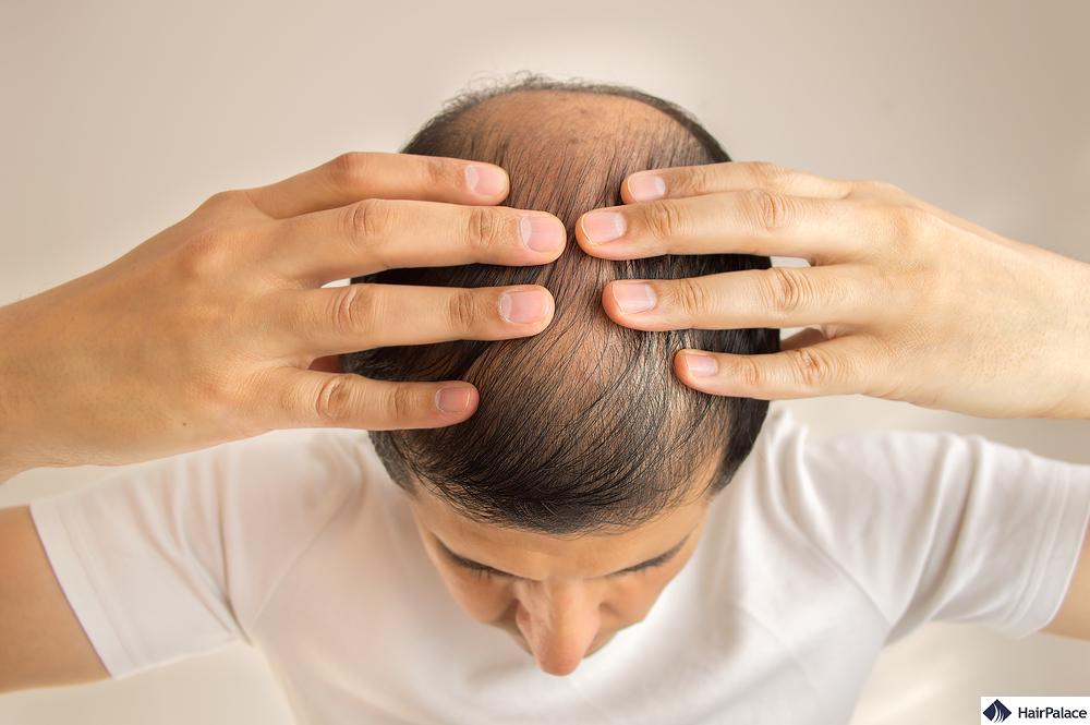 Cosa può fare per prevenire la caduta dei capelli