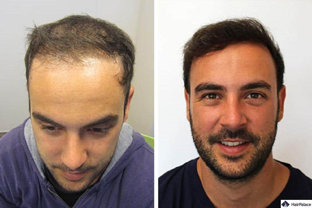 Trapianto di capelli del giovane Cyril