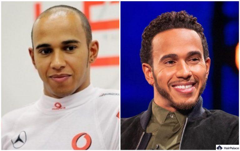 Lewis Hamilton prima e dopo il trapianto di capelli