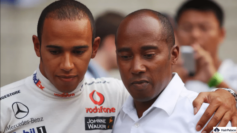 Il diradamento dell'attaccatura dei capelli di Lewis Hamilton segue il modello di perdita dei capelli di suo padre