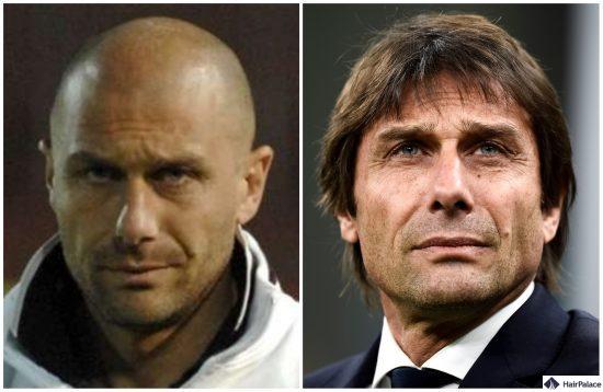 antonio conte trapianto di capelli fue2