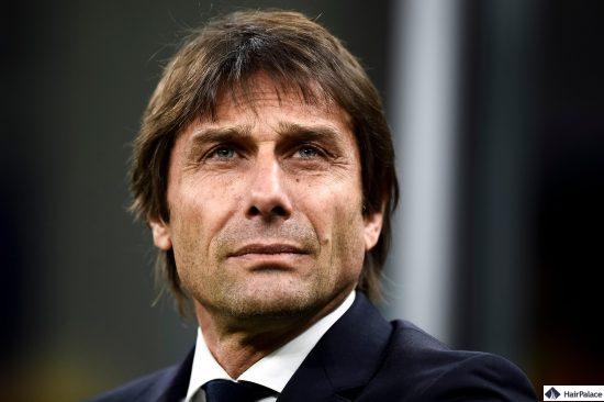 Antonio conte trapianto di capelli risultati