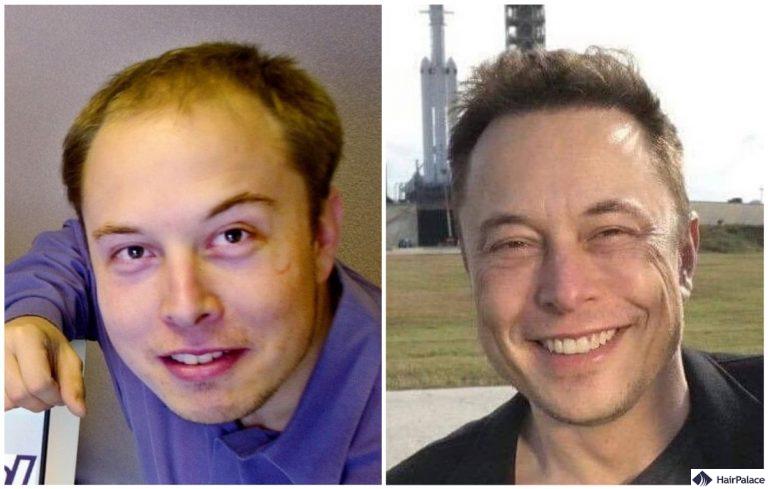 elon musk trapianto di capelli