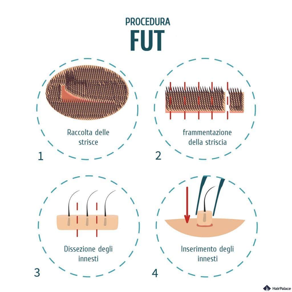 trapianto di capelli FUT