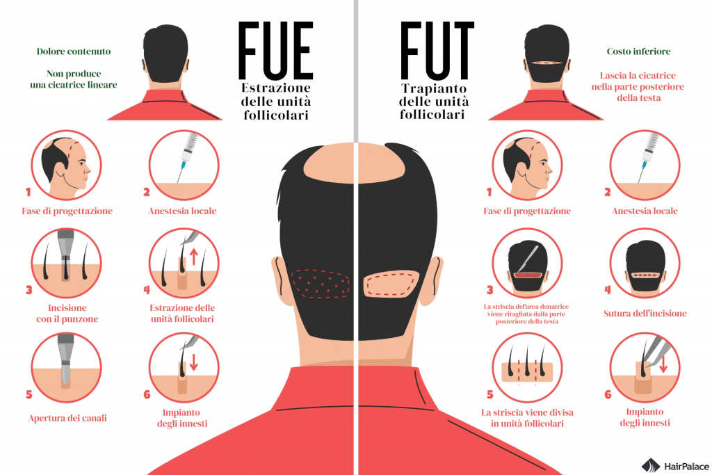 trapianto di capelli fue vs fut