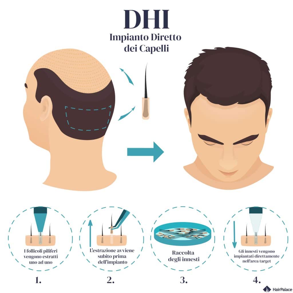 DHI trapianto di capelli