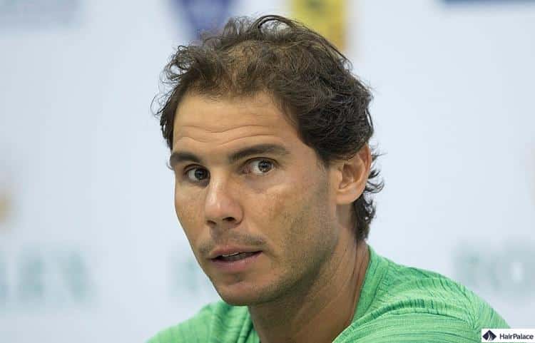 Rafael Nadal caduta dei capelli