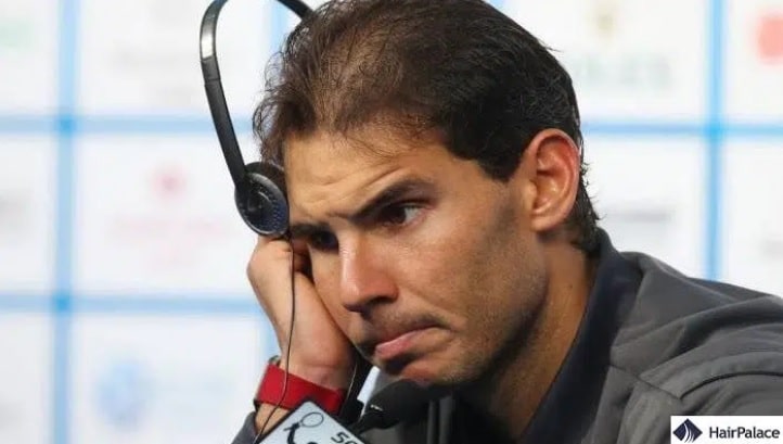 Rafael Nadal trapianto di capelli