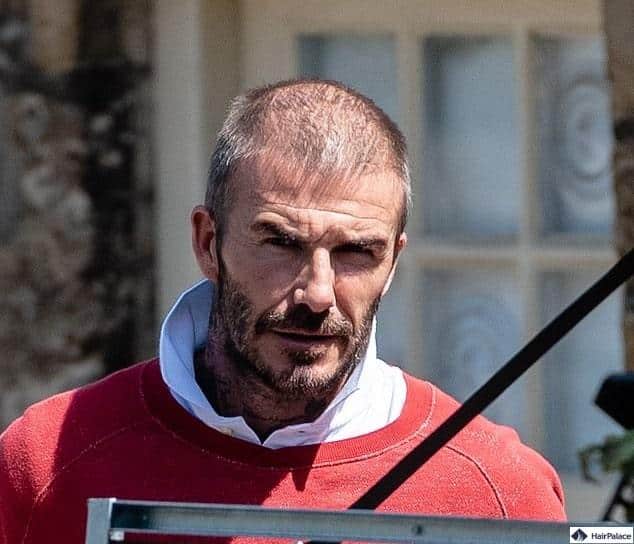 David Beckham chirurgia dei capelli