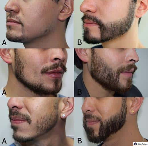 Risultati del trapianto barba