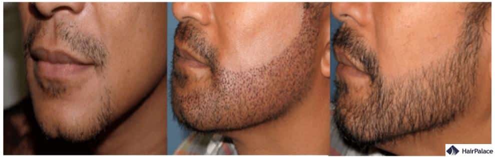 Risultati del trapianto barba