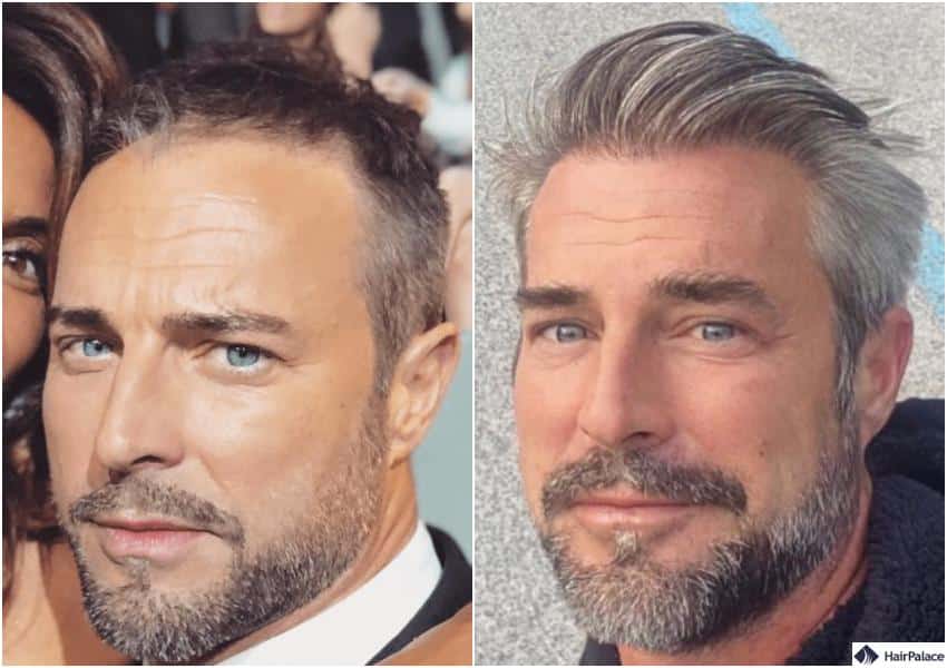 Flavio Montrucchio ha Fatto il Trapianto di Capelli?