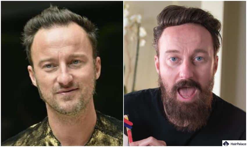 francesco facchinetti trapianto capelli