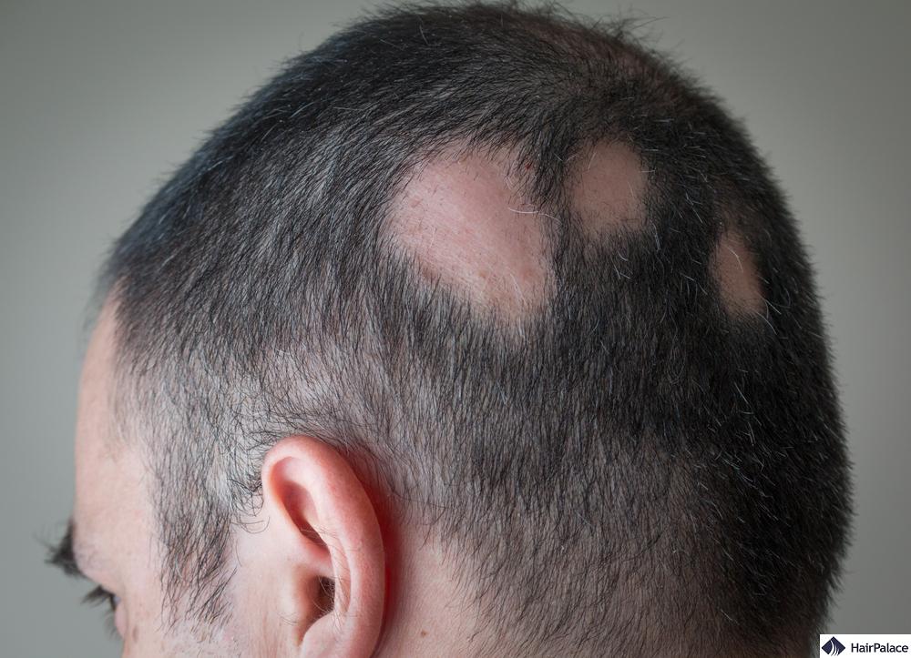 l'alopecia areata può provocare una diffusa caduta dei capelli