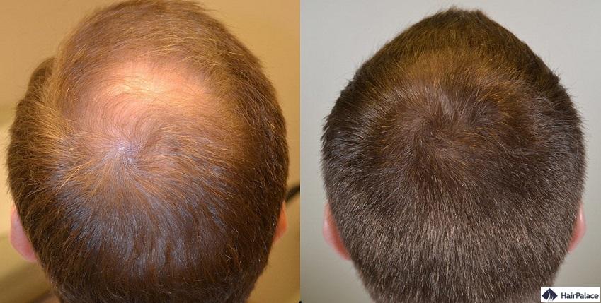 finasteride risultati