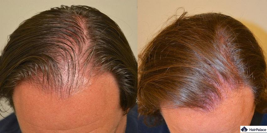 Finasteride dopo risultati