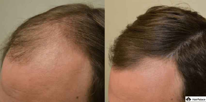 finasteride prima e dopo