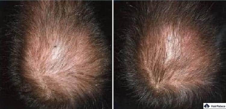 Rogaine prima e dopo