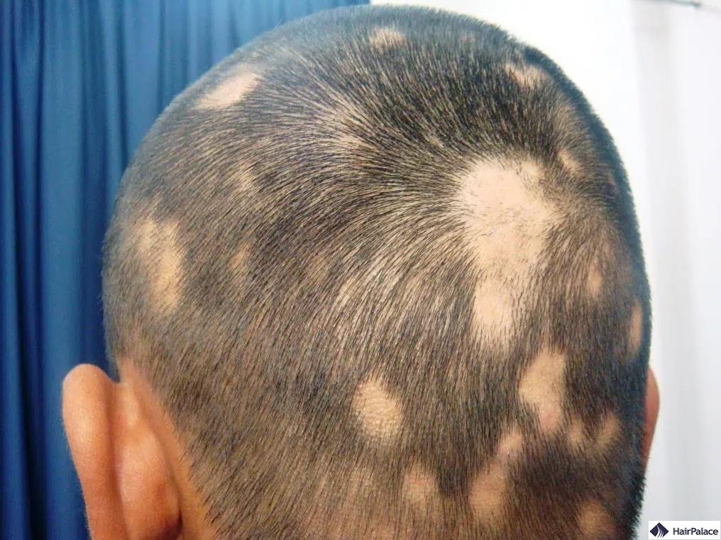 forme di alopecia areata