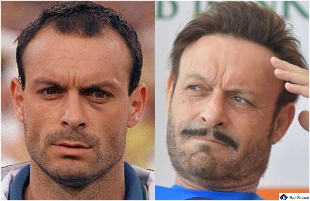 toto schillaci trapianto di capelli risultati