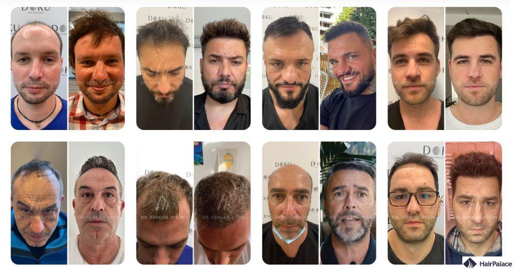 Trapianto di capelli prima e dopo dal Dr Serkan Aygin