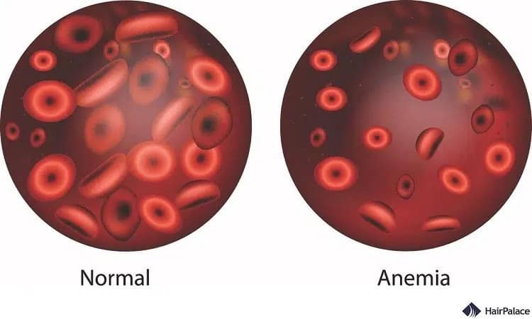 anemia che causa perdita di capelli