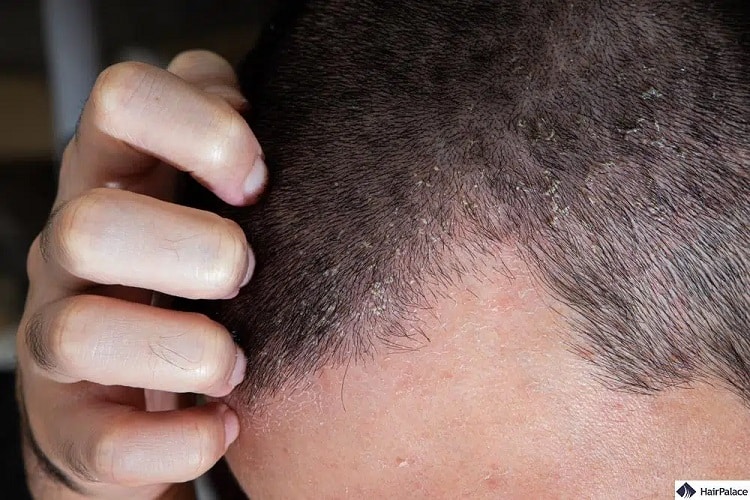 infezione del cuoio capelluto che causa la caduta dei capelli