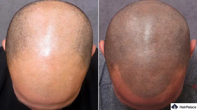 tatuaggi per capelli prima e dopo