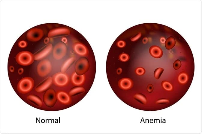 la caduta dei capelli da anemia si verifica a causa della carenza di ferro