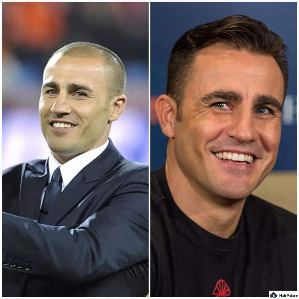 Fabio Cannavaro prima e dopo il trapianto di capelli