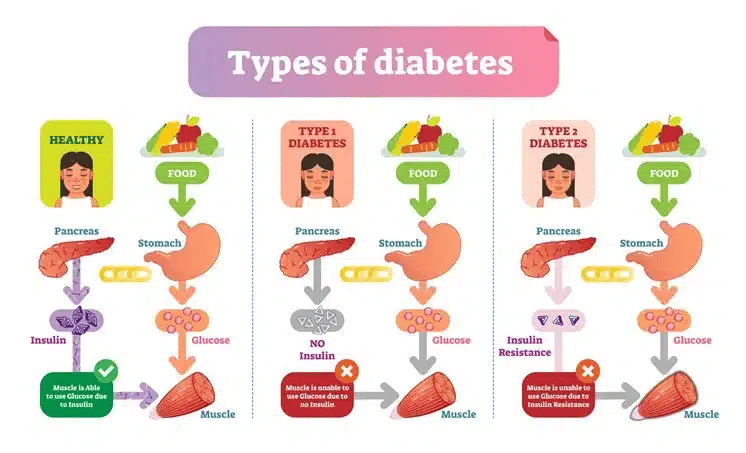 caduta dei capelli da diabete