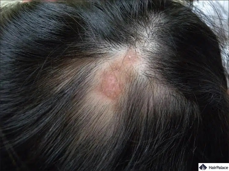 il lupus discoide può causare la caduta permanente dei capelli