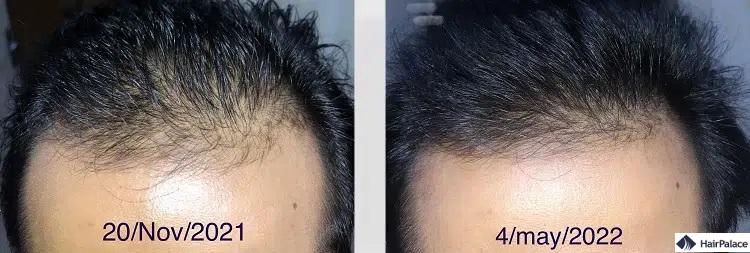 olio di rosmarino per la crescita dei capelli prima e dopo